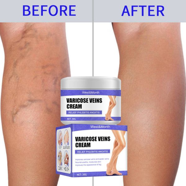 🔥LAST DAY Promotion 49% OFF🔥Vein Care Fading Cream【Buy 1 Get 1 Free】