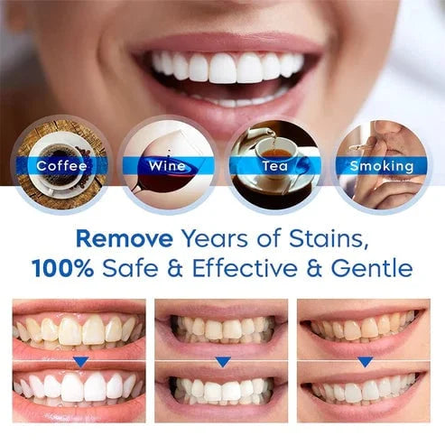 🔥Last Day Promotion 50% OFF-Teeth Whitening Essence (🔥Free shipping, cash on delivery)