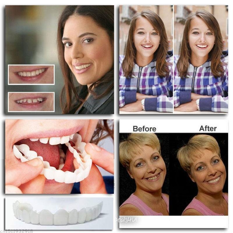 👨‍⚕Adjustable Snap-On Dentures😁100% non-inductive fit, no foreign body sensation！😁 (💥45% OFF) - 🔥HOT SALE🔥🎉