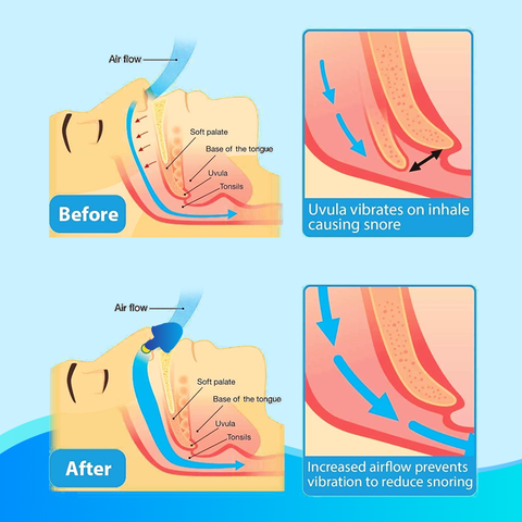 🔥Winter Promotion🔥Electric Anti Snoring Device【🇮🇳COD + Local Stock !!!】