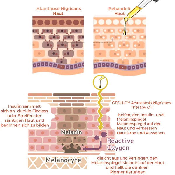 Acanthosis Nigricans Therapy Oil